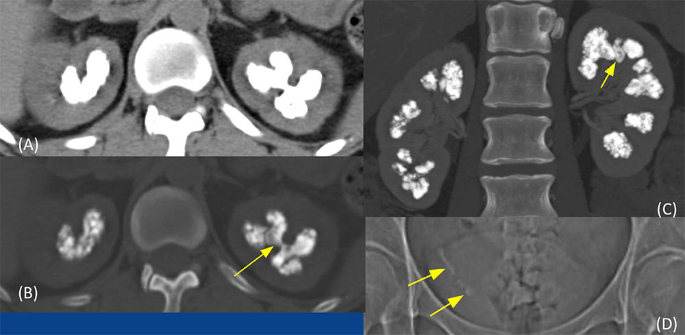 Medullary Nephrocalcinosis
